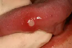 Figure 7: Aphthous ulcer (minor) frequently found on the lateral border of the tongue Figure 7: Aphthous ulcer (minor) frequently found on the lateral border of the tongue