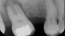 periapical radiolucency periapical radiolucency