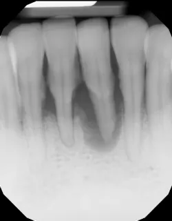 Figure 1: Initial radiograph of tooth with bone loss completely beyond apex Figure 1: Initial radiograph of tooth with bone loss completely beyond apex