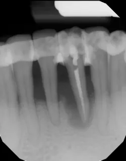 Figure 2: Radiograph after tooth had root canal therapy and was splinted Figure 2: Radiograph after tooth had root canal therapy and was splinted