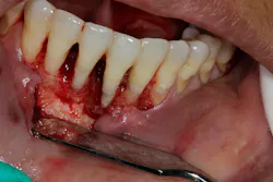 Figure 3a: Complete detoxification of the lesion and a clean bone defect Figure 3a: Complete detoxification of the lesion and a clean bone defect