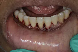 Figure 5: Tension-free closure with PeriAcryl reinforcement Figure 5: Tension-free closure with PeriAcryl reinforcement