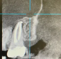 Figure 2: CBCT of same fractured tooth showing typical pattern of bone loss but no evidence of the root fracture itself Figure 2: CBCT of same fractured tooth showing typical pattern of bone loss but no evidence of the root fracture itself