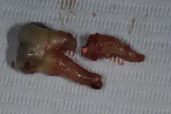 Figure 5: At 12 months without proper coronal coverage, tooth no. 31 fractures. Figure 5: At 12 months without proper coronal coverage, tooth no. 31 fractures.