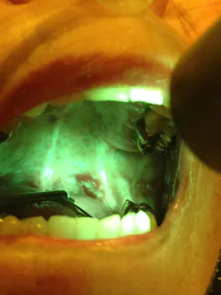Figure 2c: OralID showing carcinoma in situ Figure 2c: OralID showing carcinoma in situ