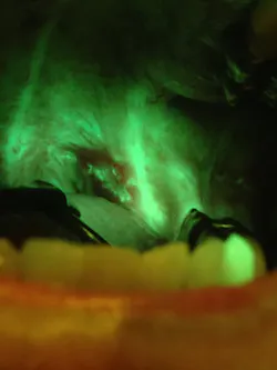 Figure 2d: OralID showing carcinoma in situ Figure 2d: OralID showing carcinoma in situ