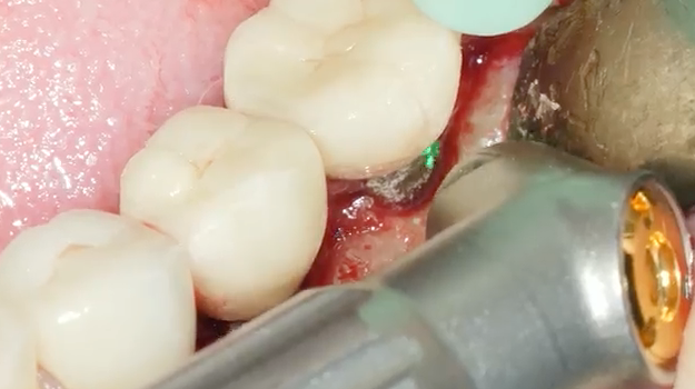 Decontamination (with a dental laser) and graft case of moderate peri-implantitis