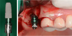 Figure 6: An implant was installed in the correct position, angulation, and depth. Figure 6: An implant was installed in the correct position, angulation, and depth.
