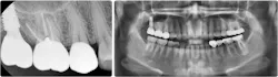 Figure 9: The implant was restored after six months. Note the PA and pan. Figure 9: The implant was restored after six months. Note the PA and pan.