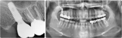 Figure 10: Follow-up at two years and 10 months. The bone level is stable. Note the successful sinus bone augmentation radiographically. Figure 10: Follow-up at two years and 10 months. The bone level is stable. Note the successful sinus bone augmentation radiographically.