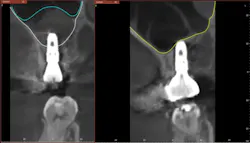 Figure 11: Comparison of immediate postoperative CBCT (left) and CBCT at two years and 10 months (right). The white line represents the original level of the sinus floor. The blue line represents the hydraulically lifted level of the sinus floor. The yellow line represents the final augmentation of the bone, which completely envelops the dental implant. Figure 11: Comparison of immediate postoperative CBCT (left) and CBCT at two years and 10 months (right). The white line represents the original level of the sinus floor. The blue line represents the hydraulically lifted level of the sinus floor. The yellow line represents the final augmentation of the bone, which completely envelops the dental implant.