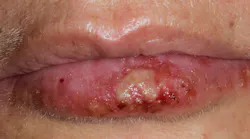 cold-sores cold-sores