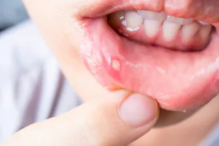Treating cold sores in two days and canker sores through glutathione  antioxidation