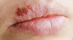 primary-herpes-lesion primary-herpes-lesion