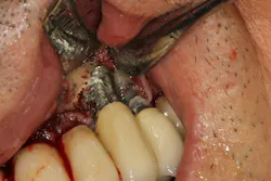 Figure 2: Osteoplasty Figure 2: Osteoplasty