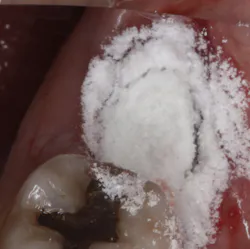 Polyox bandage prevents dry socket Polyox bandage prevents dry socket