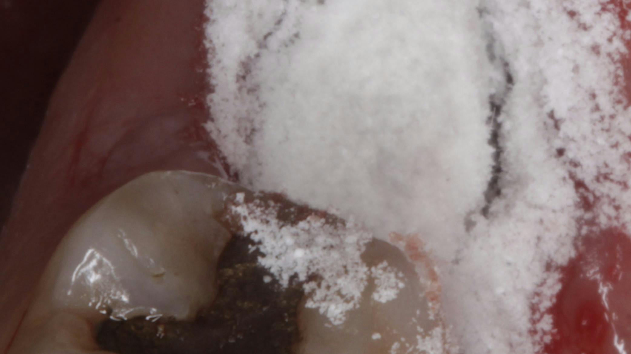 Polyox bandage to prevent dry socket