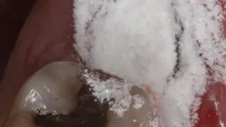 Polyox bandage to prevent dry socket Polyox bandage to prevent dry socket