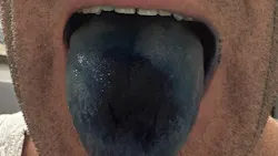 blue tongue from methylene blue blue tongue from methylene blue