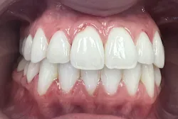 closeup of teeth closeup of teeth