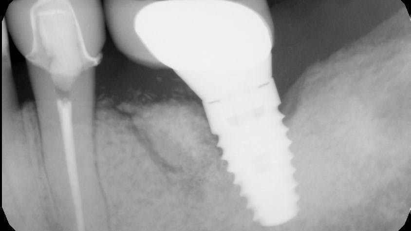 x-ray of a dental implant