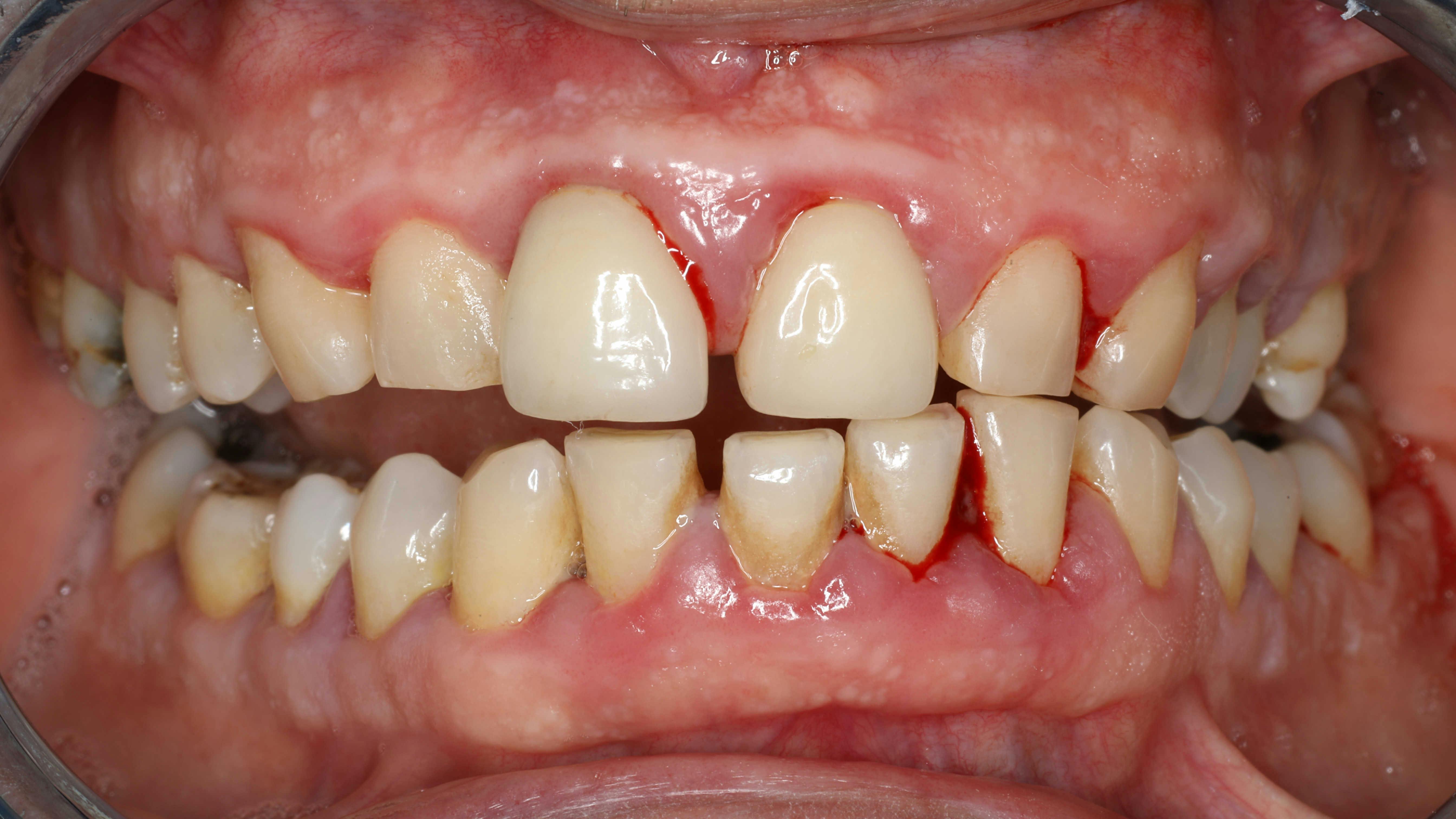 clinical photo of periodontal disease