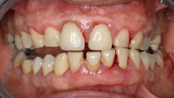 clinical photo of periodontal disease clinical photo of periodontal disease