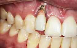 loss of soft tissue around a dental implant loss of soft tissue around a dental implant