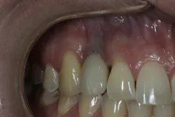loss of tissue around a dental implant loss of tissue around a dental implant