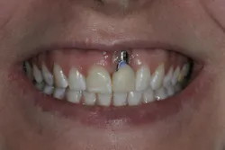 dental implant recession dental implant recession