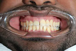 dental implant recession dental implant recession