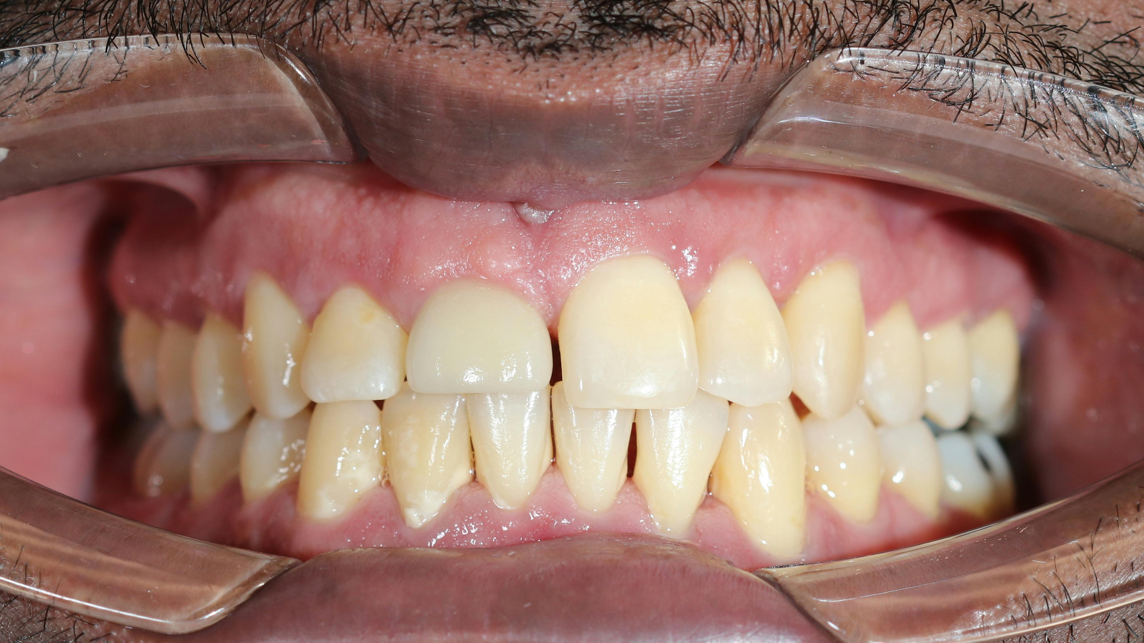 Dental implant recession around an anterior implant due to jaw-related soft tissue changes