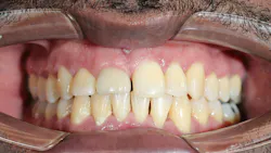 Dental implant recession around an anterior implant due to jaw-related soft tissue changes Dental implant recession around an anterior implant due to jaw-related soft tissue changes