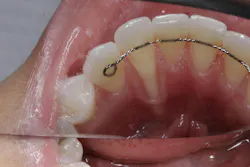 Figure 1: RT2 class recession on the lingual of mandibular anterior incisors, presenting a challenging treatment case Figure 1: RT2 class recession on the lingual of mandibular anterior incisors, presenting a challenging treatment case