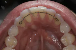 Figure 2: Six months result after soft tissue grafting with PRF and exosomes that allowed surgery to proceed without the need for harvesting a CT autogenous graft Figure 2: Six months result after soft tissue grafting with PRF and exosomes that allowed surgery to proceed without the need for harvesting a CT autogenous graft