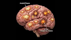 illustration of the brain with amyloid plaques and p-tau areas pointed out illustration of the brain with amyloid plaques and p-tau areas pointed out