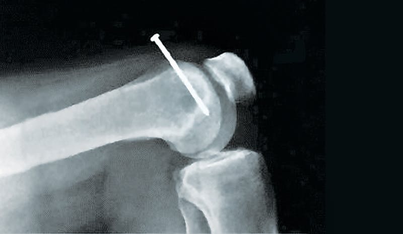 nail injuries can be far too common for remodelers