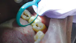 Air Abrasion Before Gas Air Abrasion Before Gas