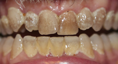 Mouth Full Of Biofilm Smaller File
