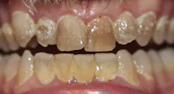 Mouth Full Of Biofilm Smaller File Mouth Full Of Biofilm Smaller File