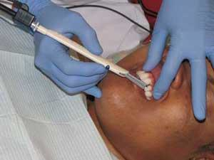 Th Roi On Probing 01