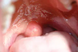Figure 2: Rounded uvula Figure 2: Rounded uvula