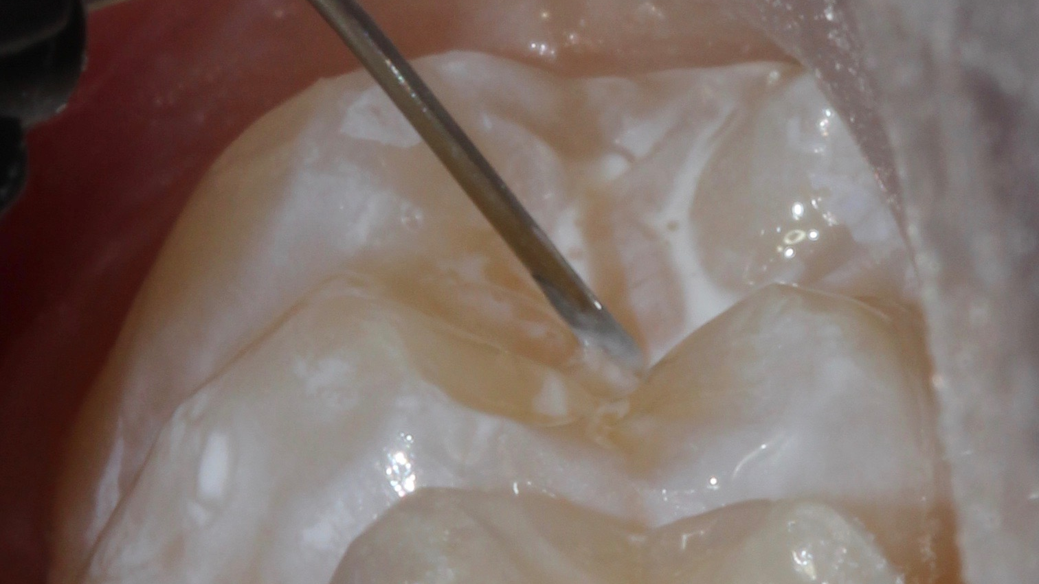 Figure 1e: Grandio Seal placement and light-curing