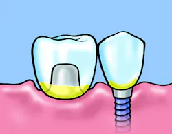 Figure 2: Application of Cervitec Plus to areas susceptible to biofilm formation. Figure 2: Application of Cervitec Plus to areas susceptible to biofilm formation.