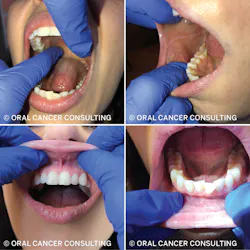Figure 1: Visualize and palpate intraoral tissues, including the hard and soft palate, labial frenums, buccal mucosa, and vestibules. Figure 1: Visualize and palpate intraoral tissues, including the hard and soft palate, labial frenums, buccal mucosa, and vestibules.