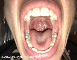 Figure 3: Examine all areas of the oropharynx. Figure 3: Examine all areas of the oropharynx.
