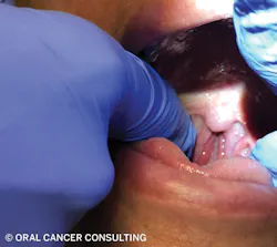 Figure 4: Palpate glossotonsillar sulcus. Figure 4: Palpate glossotonsillar sulcus.