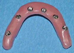 Figure 5: Convex intaglio design. Used with permission of John Hodges, DDS. Figure 5: Convex intaglio design. Used with permission of John Hodges, DDS.