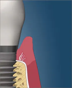 Gingiva attached to implant with weak bond. Peri-implant seal Gingiva attached to implant with weak bond. Peri-implant seal