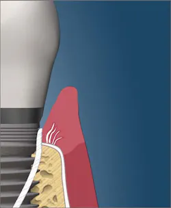 Floss with slight pressure starting to sever attachment Floss with slight pressure starting to sever attachment
